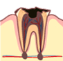 虫歯の末期